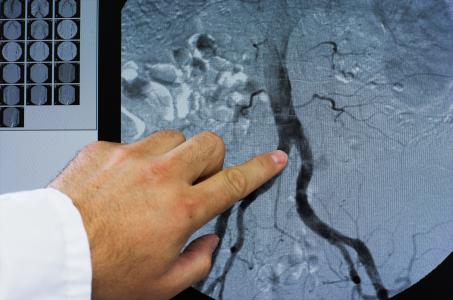 Une technique d'imagerie hospitalière utilisée couramment dans les soins contre le cancer pourrait trouver une nouvelle indication : améliorer considérablement la surveillance et le traitement de l'athérosclérose (Visuel Adobe Stock 19839128)