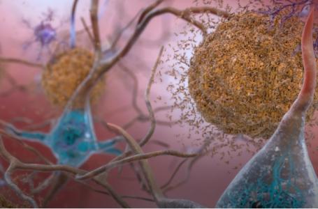Plutôt que de démarrer dans un site bien précis du cerveau, les protéines toxiques forment des agrégats un peu partout, entraînant une progression plutôt multisite mais lente de la maladie (Visuel Université du Colorado)