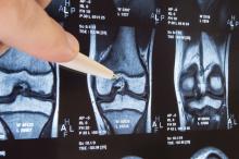 C’est un nouvel outil pour les greffes osseuses, un pistolet à colle qui permet de les effectuer en un geste, directement au site de la fracture (Visuel Adobe Stock 171289849) C’est un nouvel outil pour les greffes osseuses, un pistolet à colle qui permet de les effectuer en un geste, directement au site de la fracture (Visuel Adobe Stock 171289849)