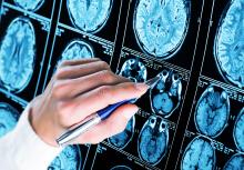 Comment diagnostiquer un trouble neurologique jusque-là insaisissable, la paralysie supranucléaire progressive (Visuel Adobe Stock 216698942) Comment diagnostiquer un trouble neurologique jusque-là insaisissable, la paralysie supranucléaire progressive (Visuel Adobe Stock 216698942)