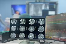 C'est une nouvelle stratégie de traitement de précision combinant profilage génétique et fonctionnel pour prédire comment le glioblastome va répondre au traitement (Visuel Adobe Stock 535437761) C'est une nouvelle stratégie de traitement de précision combinant profilage génétique et fonctionnel pour prédire comment le glioblastome va répondre au traitement (Visuel Adobe Stock 535437761)